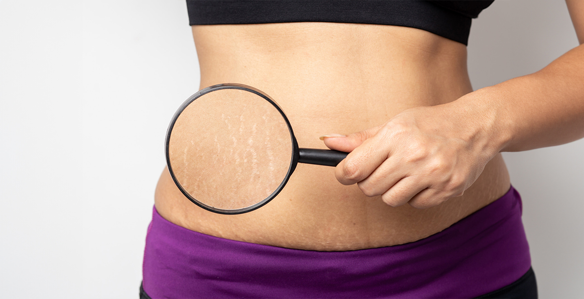 Stretch Mark Treatment