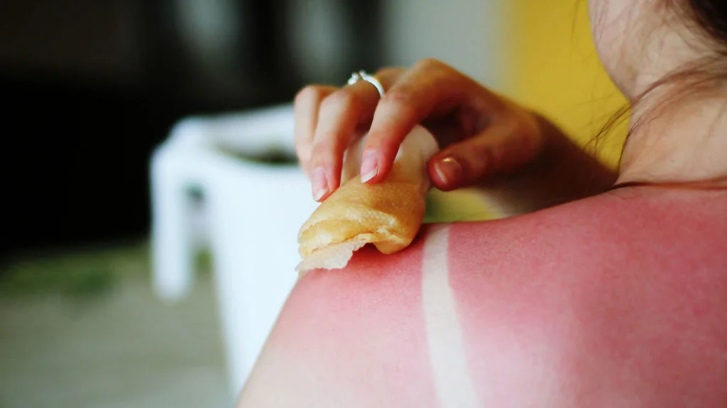 Sunburn Relief Treatment