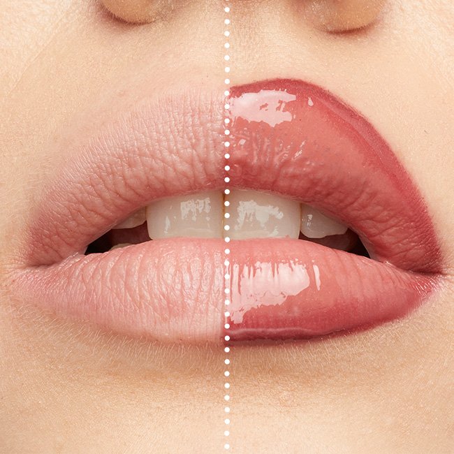 Lip Contouring
